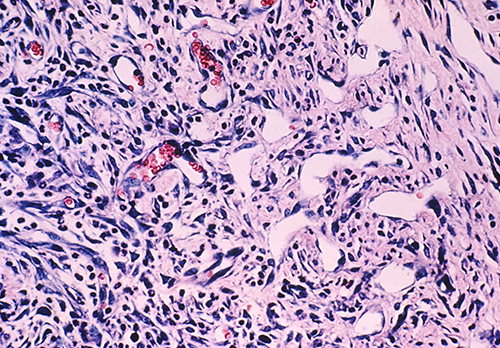 Kaposi sarcoma